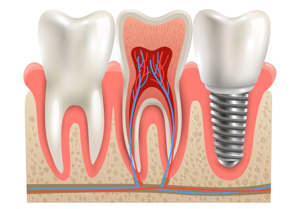 Dental implant and real tooth anatomy closeup cut away section model side view realistic vector illustration